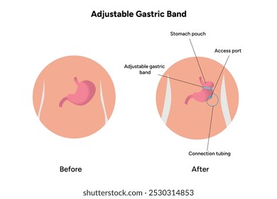 Adjustable Gastric Band. Medical gastroenterology infographic