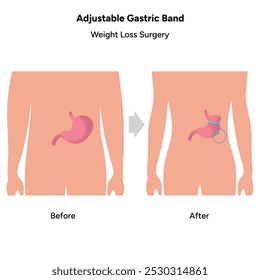 Faixa Gástrica Ajustável. Gastroenterologia médica infográfica