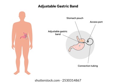 Adjustable Gastric Band. Medical gastroenterology infographic