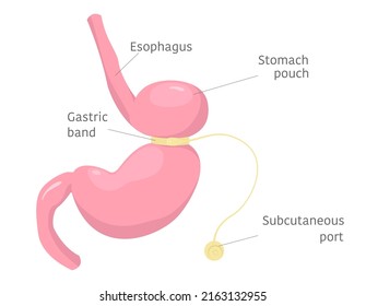 Adjustable gastric band on stomach. Human anatomy illustration for infographics, atlas, textbook or study material.