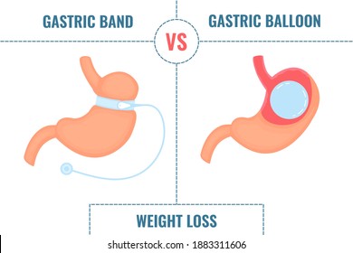 Adjustable gastric band vs gastric balloon. Bariatric surgery weight loss procedures comparison. Stomach reduction anatomical diagram infographics. Health care  medical concept. Vector illustration.
