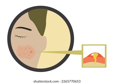 Adolescent Skin Problem concept. Editable Clip Art.