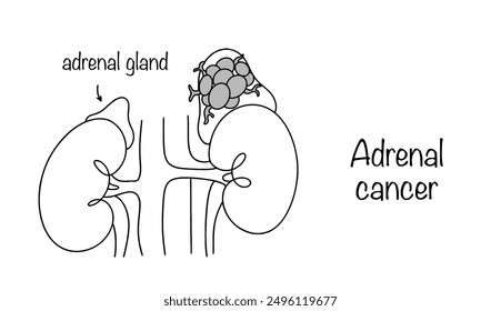 Adrenal cancer. A rare cancer in which a malignant tumor forms in one or both adrenal glands from epithelial tissue. Medical black and white illustration. Vector illustration.