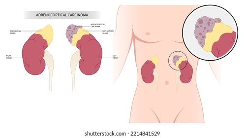 Cáncer adrenal de anatomía médica renal