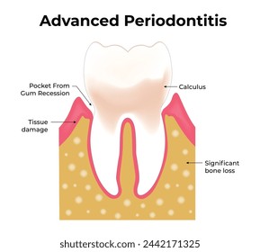 Advanced Periodontitis Science Design Vector Illustration Diagram