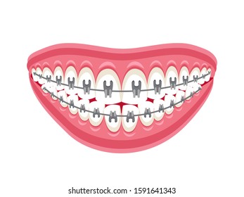 Aesthetic dental braces on teeth in open smiling mouth on white. Corrective orthodontics tools. Tooth bite alignment and correction. Stomatology and dentistry. Vector flat cartoon illustration