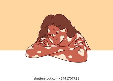 African American woman with vitiligo syndrome and spots on skin smiles, leaning elbows on white surface. Beautiful vitiligo girl calls for attention to dermatological problems caused by pigmentation