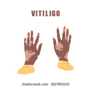African female hands with vitiligo. World vitiligo day. Skin disease. Self care and self love. Vector illustration in flat cartoon style.