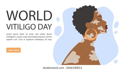 Afro american woman illustration with vitiligo banner. World Vitiligo Day