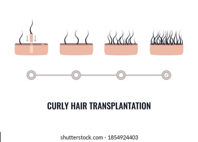 Afro-textured hair transplantation surgery steps infographics. Skin cross-section diagram of curly hair loss treatment with FUE method. Treating alopecia medical poster. Vector illustration.