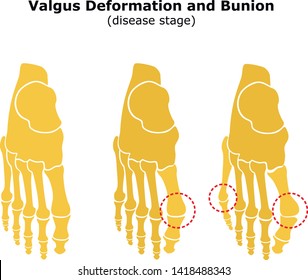 Age and valgus deformity of the thumb. Bunion. Stages of development of the disease. Silhouette of the foot bones. Vector illustration