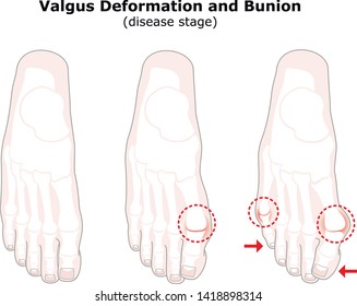 Age Valgus Deformity Thumb Bunion Stages Stock Vector (Royalty Free ...