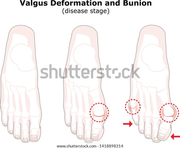 Age Valgus Deformity Thumb Bunion Stages Stock Vector Royalty Free