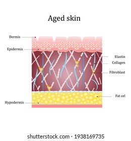 Aged Skin Layer. Structure Human Aged Skin With Collagen And Elastin Fibers, Fibroblasts. Vector Diagram