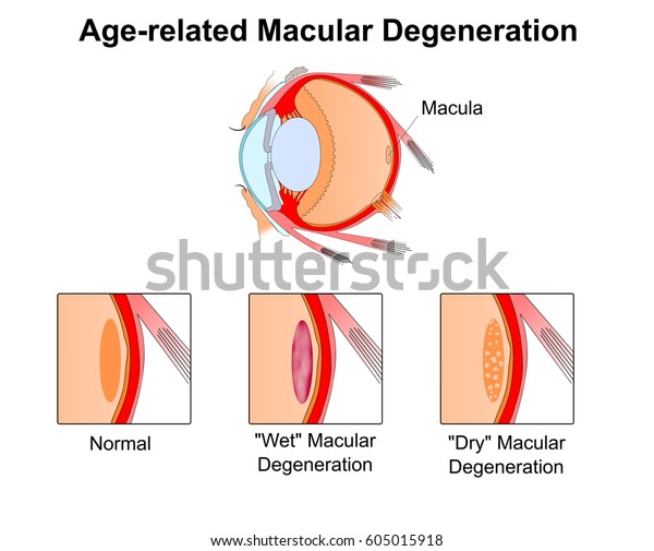 Age-related macular degeneration.Eye vision\
disorder.Diagram of the\
eye