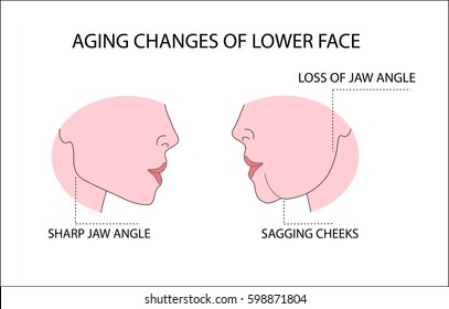 Aging changes of lower face 