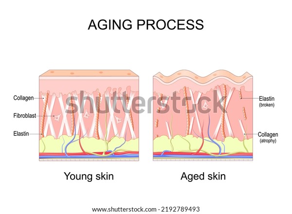 Aging process. comparison of Young and aged skin.\
Collagen, Elastin and fibroblasts in younger and older skin.\
age-related changes in the skin when Collagen fibers atrophy, and\
Elastin broken. Vector