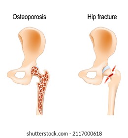 aging process in the human bones. Osteoporosis that caused of Hip fracture. vector illustration. medical poster