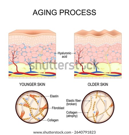 Aging process. Younger and older skin. Close-up of collagen and elastin fibers, and fibroblasts. Age-related changes. collagen fiber atrophy, elastin degradation, and hyaluronic acid depletion