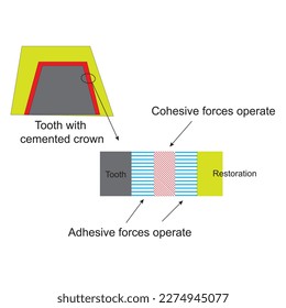 Ahesive and cohesive Forces operating within a cemented restoration, the phenomena of adhesion and cohesion are reviewed and discussed with particular reference to dentistry, vector  illustration 