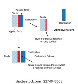 Ahesive and cohesive joint failure, the phenomena of adhesion and cohesion are reviewed and discussed with particular reference to dentistry, this review considers the forces involed 