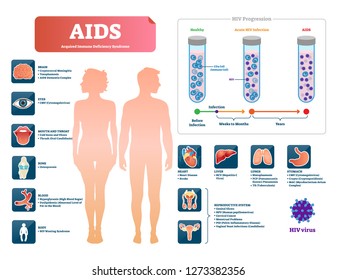 AIDS Or HIV Vector Illustration. Labeled Medical Diagram With Virus Symptom. Educational Infographic With Patient Immune Deficiency Syndrome Diagnosis. Explanation Of Infection Progression And Stages.