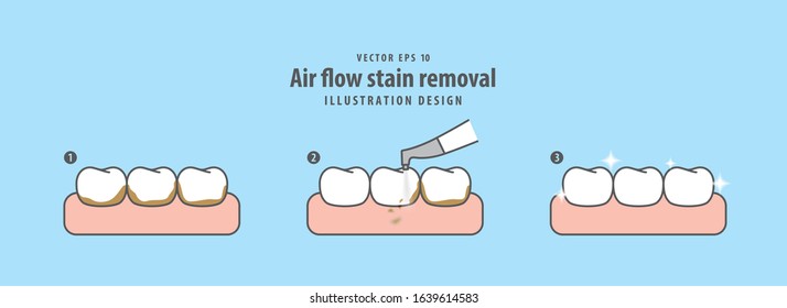 Air flow stain removal and teeth cleaning step illustration vector on blue background. Dental concept.