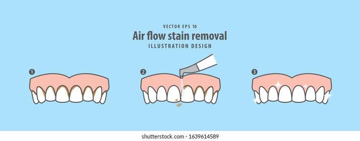 Air flow stain removal and teeth cleaning step (upper) illustration vector on blue background. Dental concept.