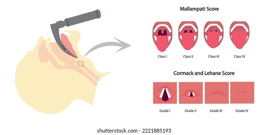 Airway managment illustration.Intubation with laryngoscopy. Mallampati and Comark lehane score assesment of airway difficult for intubation.