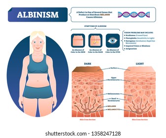 Albinism vector illustration. Labeled medical melanin pigment loss scheme. Genetic problem with skin, eyes, eyebrows and hair color symptoms. Compared normal skin cross section with lack of melanocyte