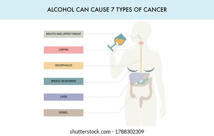 Alcohol can cause 7 types of cancer