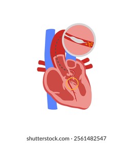 Alcohol Septal Ablation, Cardiovascular Disease Illustration Icon