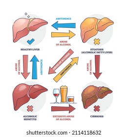 Alcoholic Liver Disease From Excessive Abuse Of Alcohol Outline Concept. Labeled Educational Scheme With Abstinence Causes, Cirrhosis And Hepatitis Vector Illustration. Anatomical Impact Of Drinking.