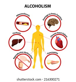 Alcoholismo. Algunos de los posibles efectos a largo plazo del alcohol pueden producirse en una persona: aterosclerosis, cirrosis, pancreatitis, daño a la función cerebral, insuficiencia cardíaca, disfunción reproductiva.  