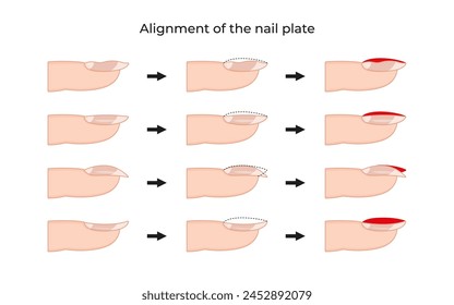 Alignment Of The Nail Plate -01