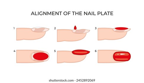 Alignment of the nail plate -02