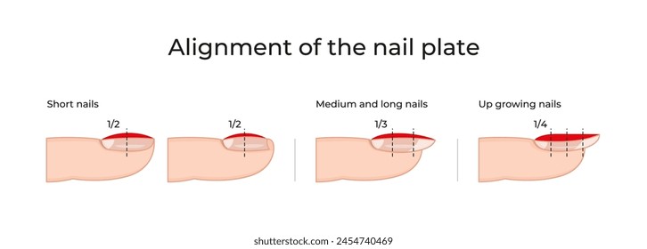 Alignment of the nail plate -05