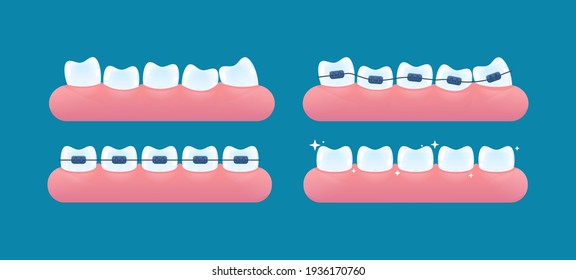 Alignment of teeth and bite correction with the help of braces system. Vector cartoon style.