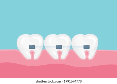 Alignment of teeth and bite correction with the help of braces system. Vector cartoon style. Vector illustration