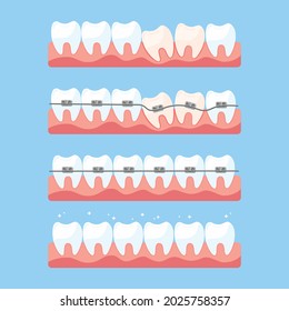 Alignment Teeth Braces Set Stock Vector (Royalty Free) 2025758357 ...