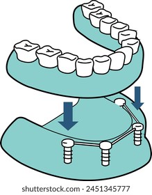 All on 4 dental implants dental treatment surgery - flat illustration   