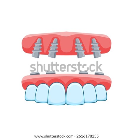 All on 4 Dental Implants Flat Icon Cartoon Illustration