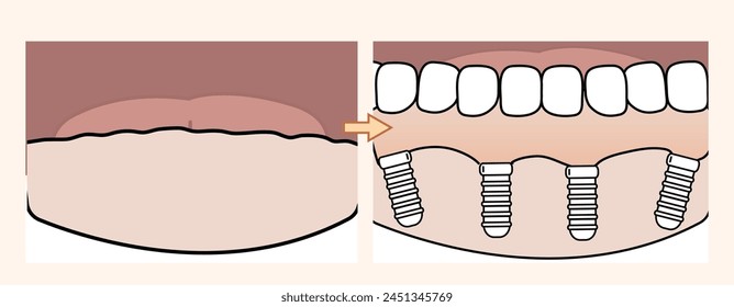 All on 4 dental treatment process  