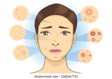 All Type Of Acne Icon From Facial Skin Of Woman. Illustration About Dermatology Diagram.