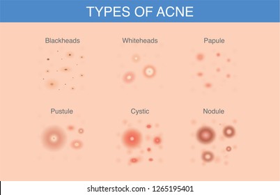 All Types of Acne appear on suface of the skin.  Illustration about skin care and problems.