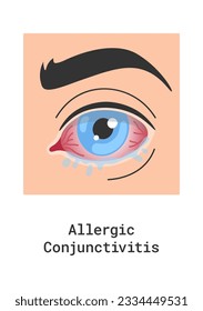 Allergic Conjunctivitis Eye Disease Vector Illustration