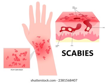 Allergic Eczema Scabies mites cause hand skin red itching and inflammation