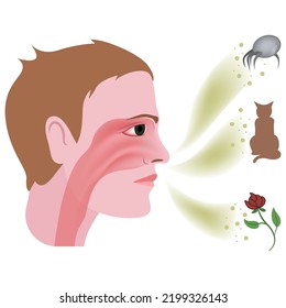 allergic rhinitis. Disease, with swelling and inflammation of the nasal mucosa. Reaction to grass or tree pollen, house dust mites. Vector illustration.