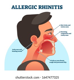 Allergic Rhinitis Medical Diagram, Vector Illustration Labeled Information. Patient Symptoms Like Red, Itchy Eyes, Sneezing And Runny Nose, Sore Throat And Buzzing Sound In Ears. Head Cross Section.