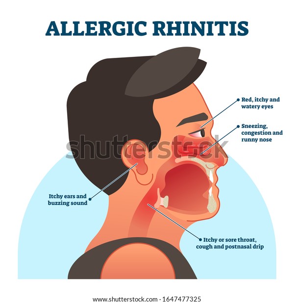 アレルギー性鼻炎の医療図 ベクターイラスト ラベル情報 赤いかゆい目 くしゃみ 鼻水 喉の痛み 耳のうなり声など 患者の症状 ヘッドの断面 のベクター画像素材 ロイヤリティフリー